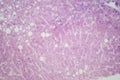Hepatic steatosis, light micrograph Royalty Free Stock Photo