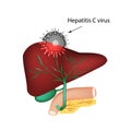 Hepatitis C. The introduction of the hepatitis C virus in the liver.