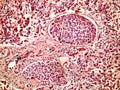 Hepatocellular cancer of liver of a human