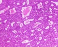 Hepatocellular carcinoma of a human