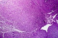 Hepatocellular carcinoma, light micrograph