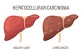 Hepatocellular carcinoma, liver diseases. Healthy liver and liver cancer. Medical infographic banner.