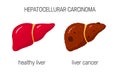 Liver cancer concept