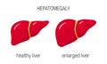 Hepatomegaly concept