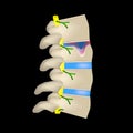 Hernia Schmorl. Intervertebral disc. Side view. Spine. Infographics. Vector illustration on a black background