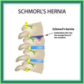 Hernia Schmorl. Intervertebral disc. Side view. Spine. Infographics Vector illustration on isolated background