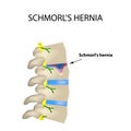 Hernia Schmorl. Intervertebral disc. Side view. Spine. Infographics Vector illustration on isolated background