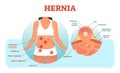 Hernia types vector illustration and cross section of muscle rupture and intestine. Royalty Free Stock Photo