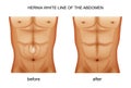 Hernia white line of the abdomen