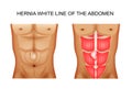 Hernia white line of the abdomen 2