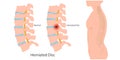 Herniated disc is also known as a slipped Royalty Free Stock Photo