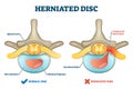 Herniated disc injury as labeled spinal pain explanation vector illustration Royalty Free Stock Photo