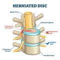 Herniated disc injury 3D side view on spine bone skeleton vector illustration Royalty Free Stock Photo