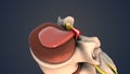 Herniated disc of the lumbar spine Royalty Free Stock Photo