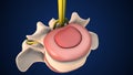 Medical animation of a herniated disc in the lumbar spine Royalty Free Stock Photo