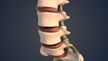 Herniated disc of the lumbar spine