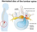 Herniated disc of the lumbar spine, stenosis, slipped disc, labeled illustration Royalty Free Stock Photo