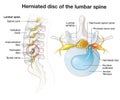 Herniated disc of the lumbar spine, stenosis, slipped disc. Medical illustration Royalty Free Stock Photo