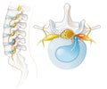 Herniated disc of the lumbar spine, stenosis, slipped disc. Medical illustration