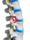 Herniated disk