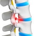 Herniated disk Royalty Free Stock Photo