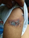 herpes disease that has dried and will recover