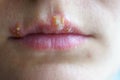 Herpes disease on the lips of a young girl
