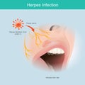 Herpes Infection. Illustration human facial nerve skin for use explain herpes.