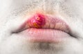 Herpes labialis on the lip of a Caucasian man. Face close-up..ÃÂ¡old sores illness disease. Simplex virus Royalty Free Stock Photo