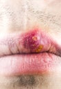 Herpes labialis on the lip of a Caucasian man. Face close-up..ÃÂ¡old sores illness disease. Simplex virus Royalty Free Stock Photo