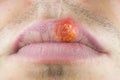 Herpes labialis on the lip of a Caucasian man. Face close-up..ÃÂ¡old sores illness disease. Simplex virus Royalty Free Stock Photo