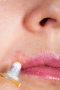 Herpes on the lip close-up macro. Woman lubricates the labial herpes ointment