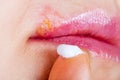 Herpes on the lip close-up macro. Woman lubricates the labial herpes ointment Royalty Free Stock Photo