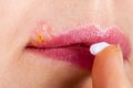 Herpes on the lip close-up macro. Woman lubricates the labial herpes ointment Royalty Free Stock Photo