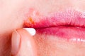 Herpes on the lip close-up macro. Woman lubricates the labial herpes ointment