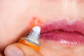 Herpes on the lip close-up macro. Woman lubricates the labial herpes ointment