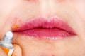 Herpes on the lip close-up macro. Woman lubricates the labial herpes ointment