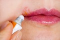 Herpes on the lip close-up macro. Woman lubricates the labial herpes ointment Royalty Free Stock Photo