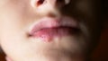 Herpes on the lips of a boy. herpes. lip treatment. 4k, slow-motion shooting, copy space