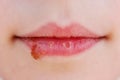 Herpes on lips of child. Treatment ointment Royalty Free Stock Photo