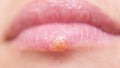 Herpes on lips