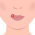 Herpes on Lips Cold Sore