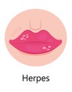 Herpes lips vector. Simplex virus infection causes recurring episodes of small, painful, fluid-filled blisters on skin