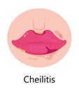 Herpes lips vector. Simplex virus infection causes recurring episodes of small, painful, fluid-filled blisters on skin