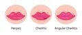 Herpes lips vector. Simplex virus infection causes recurring episodes of small, painful, fluid-filled blisters on skin