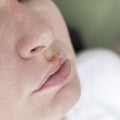 Herpes on the lips of the young woman