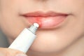 Herpes on the lips of the young woman . Woman lubricates the labial herpes ointment