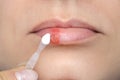 Herpes on the lips of the young woman . Woman lubricates the labial herpes ointment