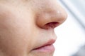 Herpes on the nose - Pretty caucasian woman with herpes her on nose, close-up. Human Virus Royalty Free Stock Photo