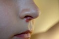 Herpes on the nose - Pretty young caucasian boy with herpes her on nose. Close-up. Human Virus Royalty Free Stock Photo